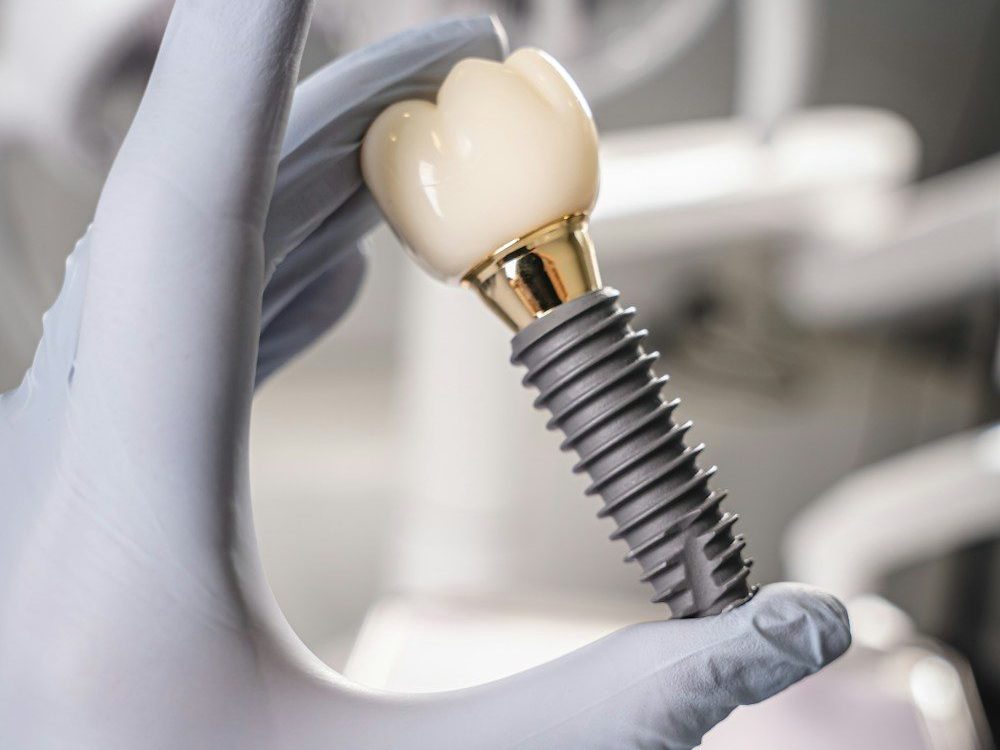 Un implant dentaire vissé à sa couronne, tenu dans une main gantée